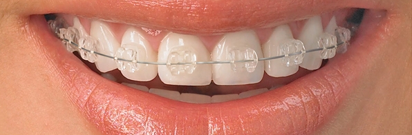 Odontologia - Aparelho ortodôntico transparente, outros tipos e dicas úteis