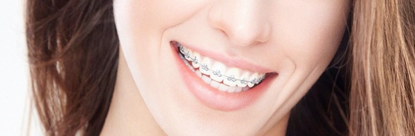 Odontologia - Aparelho ortodôntico x sensibilidade: Será que posso usar?