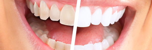 Odontologia - Como conservar o efeito do clareamento dental?