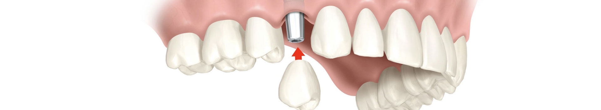 Conheça alguns detalhes importantes antes de fazer o implante dental