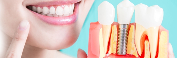 Odontologia - Enxerto ósseo para implante dentário: O que é, tipos e função