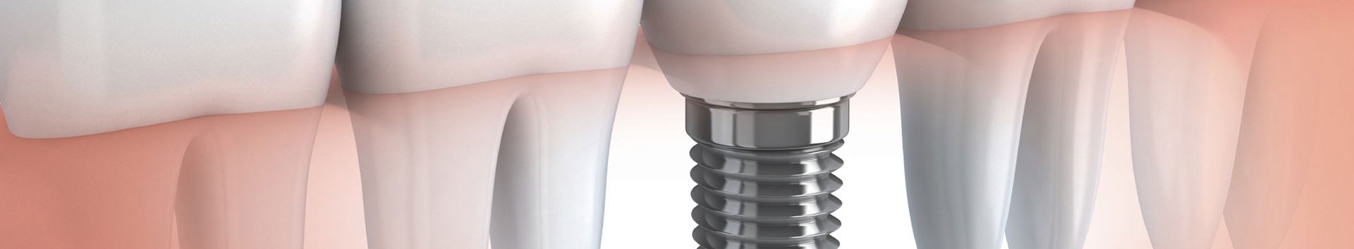 Eu necessito de um implante dental?