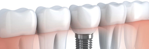Odontologia - Eu necessito de um implante dental?