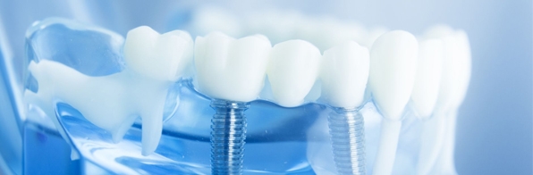 Odontologia - Implante dental: Como escolher o melhor implantodontista?