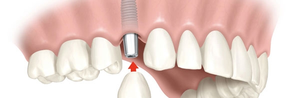 Odontologia - Implante dentário: Invista com segurança e ganhe um novo sorriso