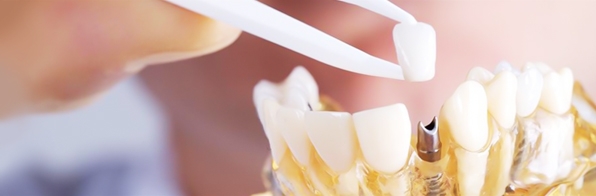 Odontologia - Implante dentário na clínica odontológica errada causa mau hálito