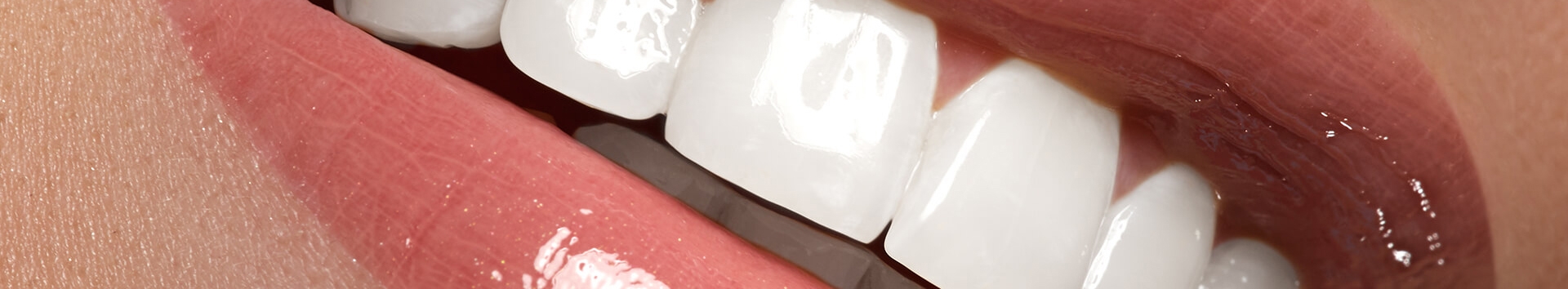 Lente de Contato Dental: Como escolher a melhor Clínica