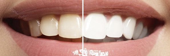 Odontologia - O que é Clareamento interno? Como é feito e se funciona para você