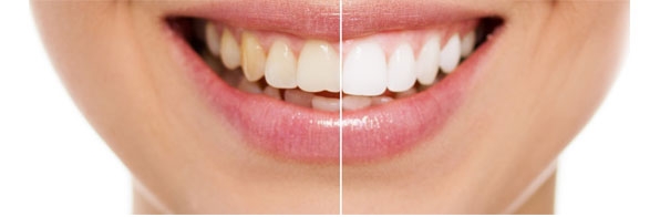 Odontologia - Quais os casos de restrição ao clareamento dentário?