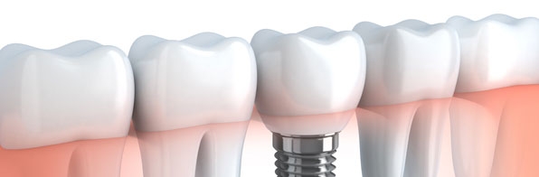 Odontologia - Que cuidados devo ter com o implante dental?