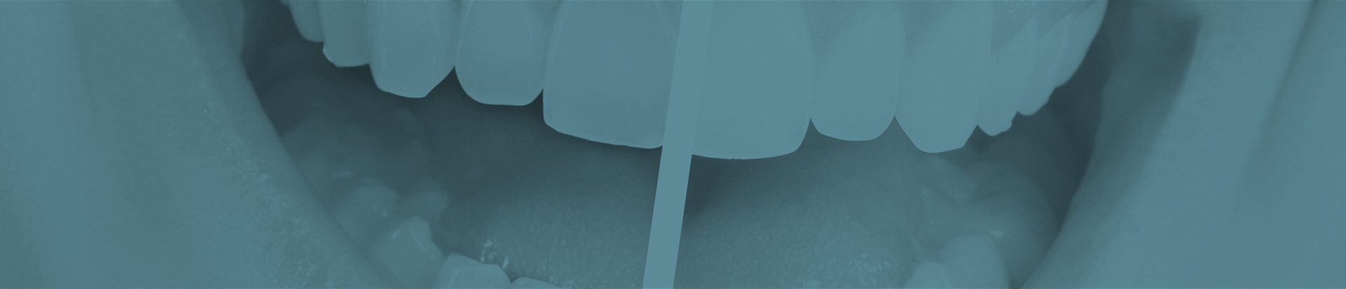 Clareamento Dental