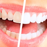 Odontologia - Clareamento Dental