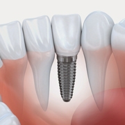 Odontologia - Implantodontia
