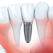 Odontologia - Próteses Dentárias